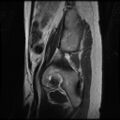 Normal female pelvis MRI (retroverted uterus) (Radiopaedia 61832-69933 Sagittal T2 30).jpg