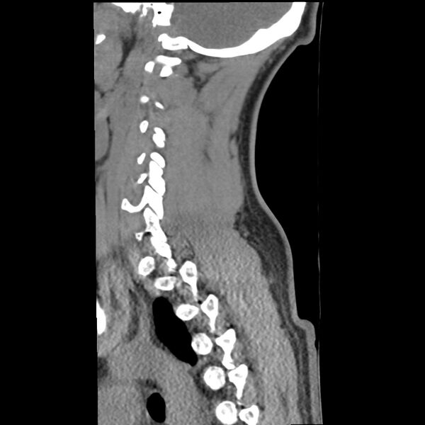 File:Normal trauma spine imaging (Radiopaedia 31753-32686 A 33).jpg