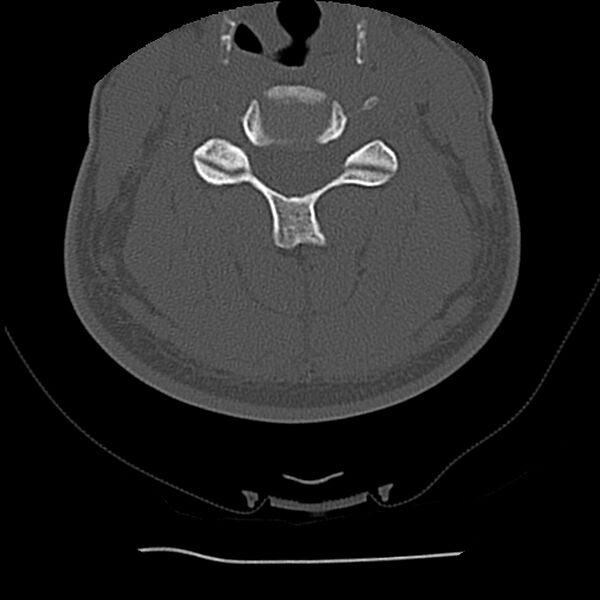 File:Normal trauma spine imaging (Radiopaedia 31753-32686 Axial bone window 43).jpg
