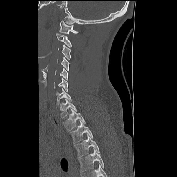 File:Normal trauma spine imaging (Radiopaedia 31753-32686 Sagittal bone window 29).jpg