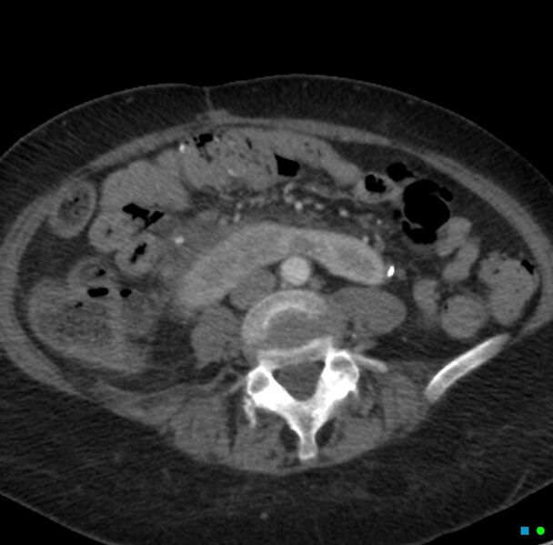 File:Obstructed infected horseshoe kidney (Radiopaedia 18116-17898 B 23).jpg