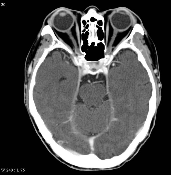 File:Occipital condyle metastasis - into mastoid (Radiopaedia 5424-7177 B 15).jpg