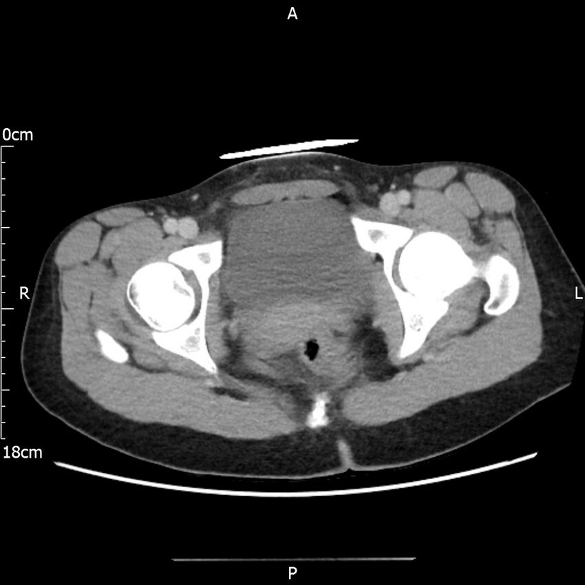 AAST grade IV kidney injury with CEUS follow-up (Radiopaedia 72353-82877 Axial C+ portal venous phase 75).jpg
