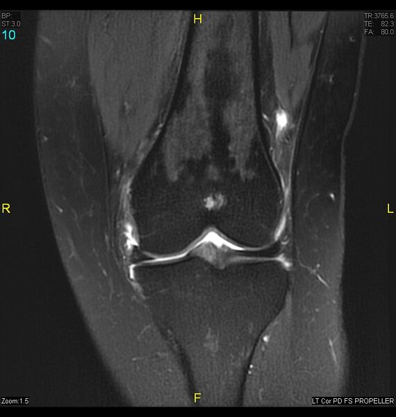 File:ACL mucoid degeration with cystic changes (Radiopaedia 48428-53341 Coronal PD fat sat 7).jpg
