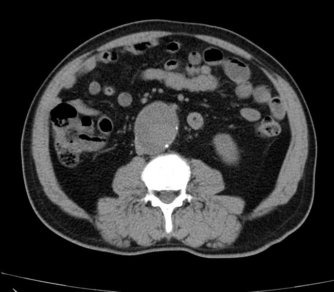 File:Abdominal aortic aneurysm (Radiopaedia 22421-22458 non-contrast 29).jpg