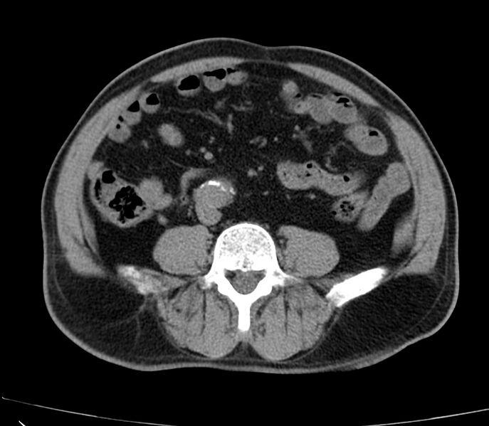File:Abdominal aortic aneurysm (Radiopaedia 22421-22458 non-contrast 33).jpg