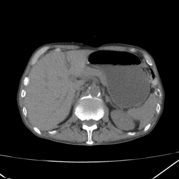 File:Abdominal aortic aneurysm (Radiopaedia 23703-23856 Axial non-contrast 14).jpg
