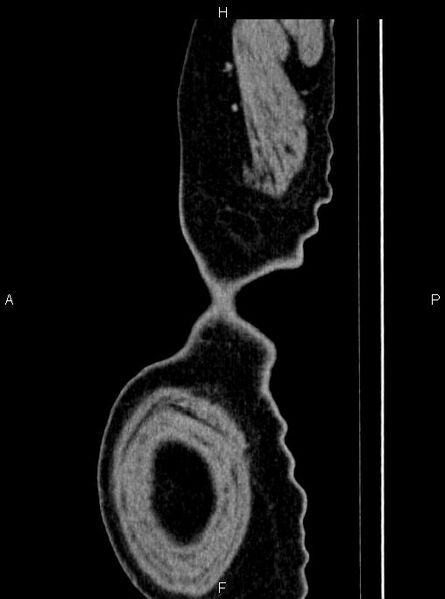 File:Abdominal aortic aneurysm (Radiopaedia 83094-97462 Sagittal renal cortical phase 125).jpg