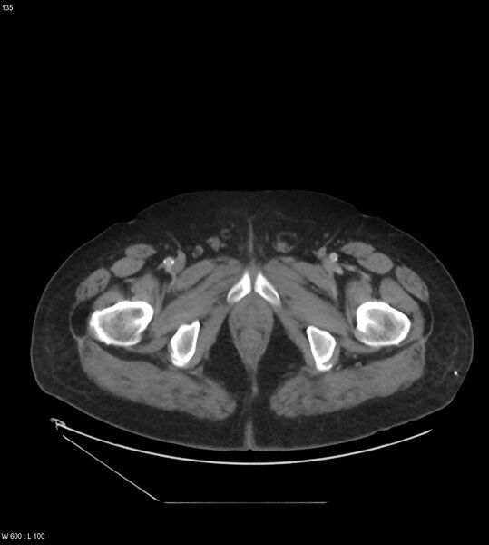 File:Abdominal aortic aneurysm with intramural hematoma then rupture (Radiopaedia 50278-55631 Axial C+ arterial phase 126).jpg