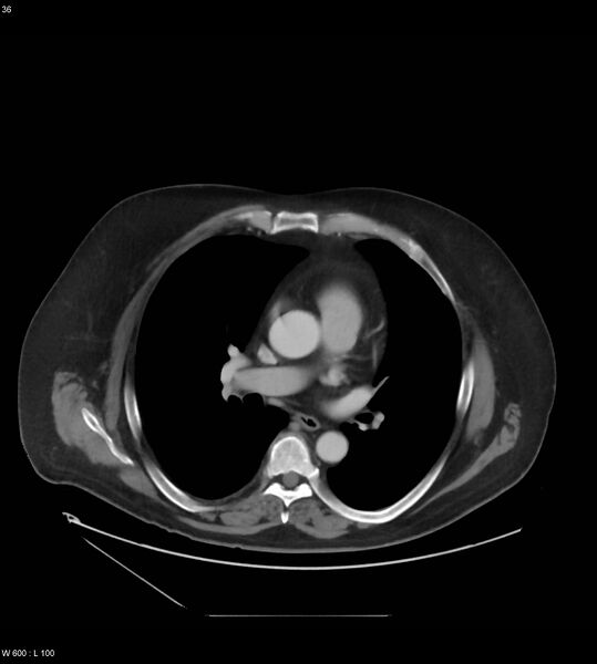 File:Abdominal aortic aneurysm with intramural hematoma then rupture (Radiopaedia 50278-55631 Axial C+ arterial phase 27).jpg