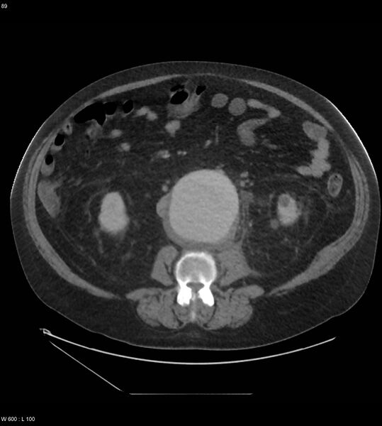 File:Abdominal aortic aneurysm with intramural hematoma then rupture (Radiopaedia 50278-55631 Axial C+ arterial phase 80).jpg