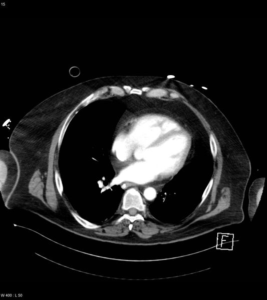 File:Abdominal aortic aneurysm with intramural hematoma then rupture (Radiopaedia 50278-55632 Axial C+ arterial phase 14).jpg