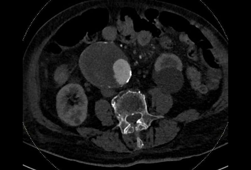 File:Abdominal aortic aneurysm with thrombus fissuration (Radiopaedia 73192-83919 Axial C+ arterial phase 117).jpg