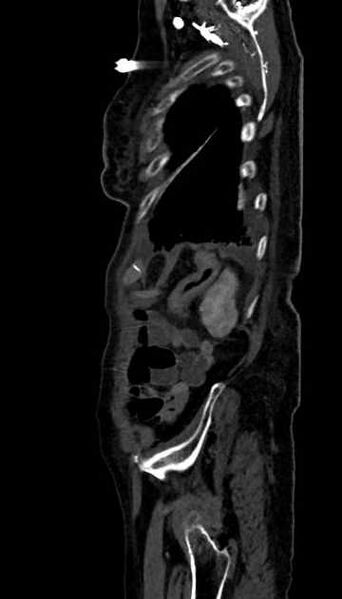 File:Abdominal aortic aneurysm with thrombus fissuration (Radiopaedia 73192-83919 Sagittal C+ arterial phase 11).jpg