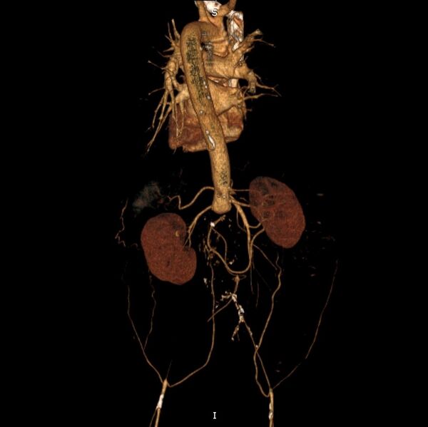 File:Abdominal aortic interposition tube graft and aneurysm thrombosis (Radiopaedia 71438-81857 3D VRT C+ arterial phase 10).jpg