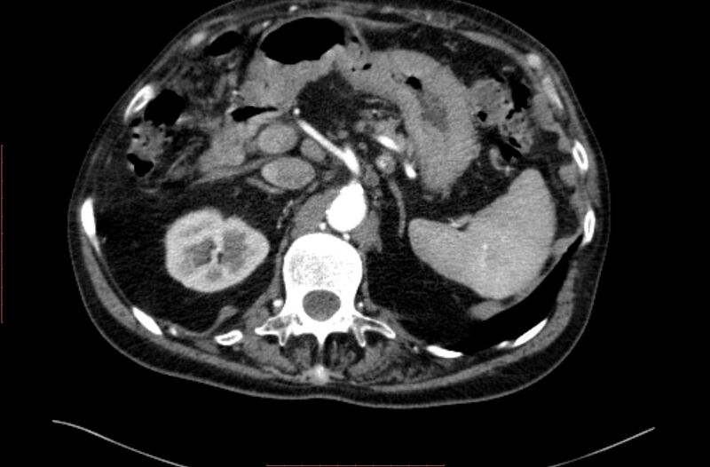 File:Abdominal aortic interposition tube graft and aneurysm thrombosis (Radiopaedia 71438-81857 Axial C+ arterial phase 19).jpg