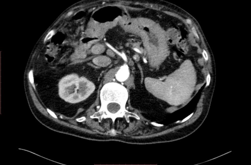 Abdominal aortic interposition tube graft and aneurysm thrombosis (Radiopaedia 71438-81857 Axial C+ arterial phase 19).jpg
