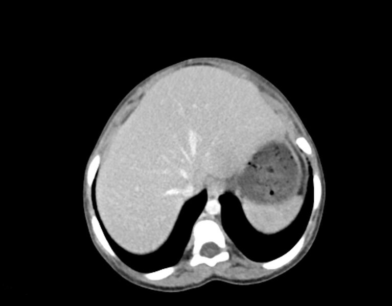 File:Abdominal premesenteric cystic lymphangioma (Radiopaedia 82995-97350 Axial C+ portal venous phase 4).jpg
