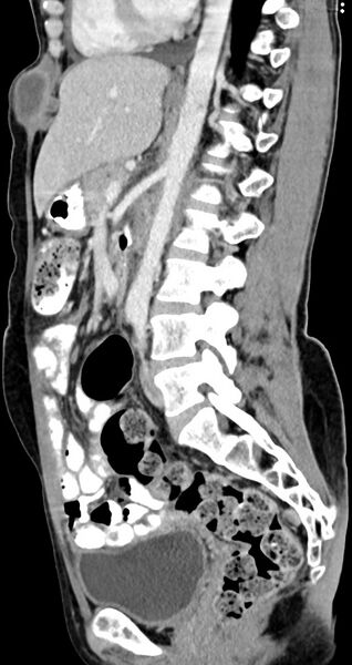 File:Abdominal wall and retroperitoneal tuberculosis (Radiopaedia 88137-104729 Sagittal C+ portal venous phase 70).jpg