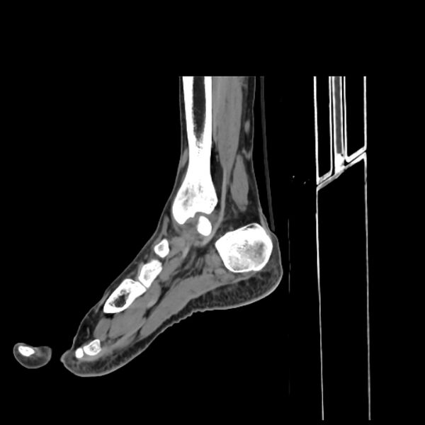File:Accessory soleus muscle (Radiopaedia 61069-68943 C 30).jpg