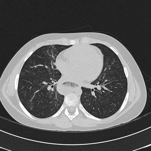 File:Achalasia (Radiopaedia 14946-14878 Axial lung window 44).jpg