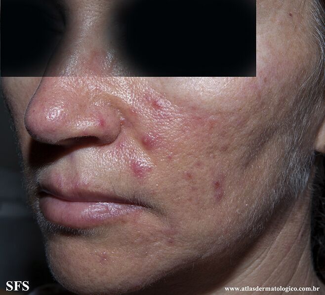 File:Acne Rosacea (Dermatology Atlas 20).jpg
