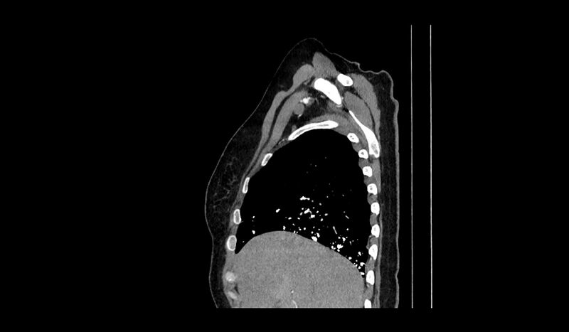 File:Acquired tracheo-esophageal fistula (Radiopaedia 51356-57103 Sagittal C+ arterial phase 15).jpg