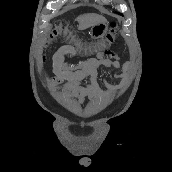 File:Active colonic bleed on CT (Radiopaedia 49765-55025 Coronal art MIP 15).jpg