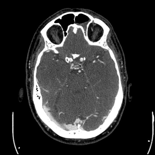 File:Acute A3 occlusion with ACA ischemic penumbra (CT perfusion) (Radiopaedia 72036-82527 Axial C+ arterial phase thins 115).jpg