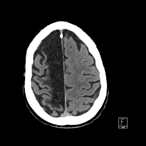 File:Acute ICA ischemic penumbra due to high-grade CCA stenosis (CT perfusion) (Radiopaedia 72038-82529 Axial non-contrast 38).jpg