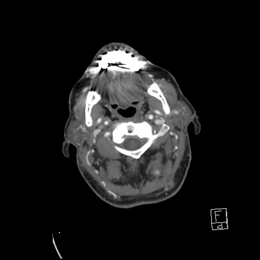 Acute ICA ischemic penumbra due to high-grade CCA stenosis (CT perfusion) (Radiopaedia 72038-82530 Axial C+ arterial phase 31).jpg