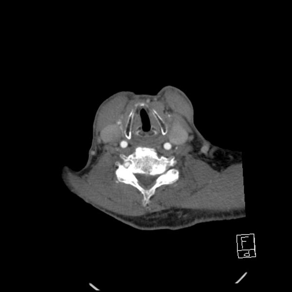File:Acute ICA ischemic penumbra due to high-grade CCA stenosis (CT perfusion) (Radiopaedia 72038-82530 Axial C+ arterial phase 56).jpg
