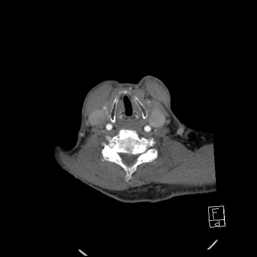 Acute ICA ischemic penumbra due to high-grade CCA stenosis (CT perfusion) (Radiopaedia 72038-82530 Axial C+ arterial phase 56).jpg