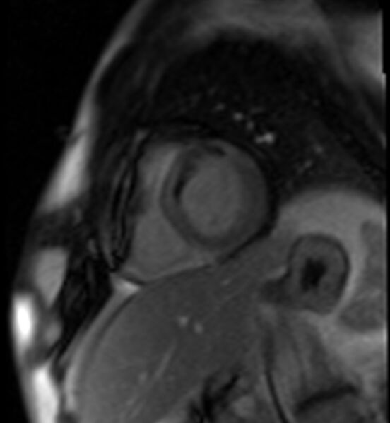 File:Acute anteroseptal myocardial infarction (Radiopaedia 68409-77945 Short axis (basal) Perfusion 38).jpg