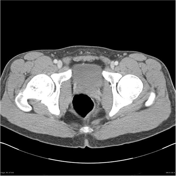File:Acute appendicitis (Radiopaedia 25364-25615 B 71).jpg