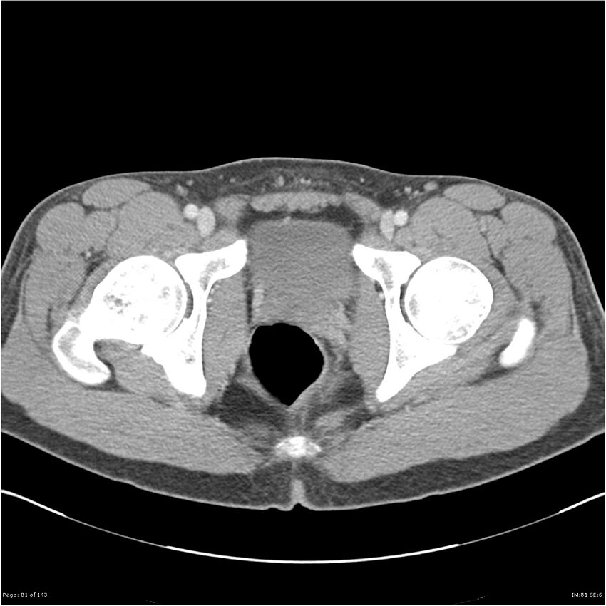Acute appendicitis (Radiopaedia 25364-25615 B 71).jpg