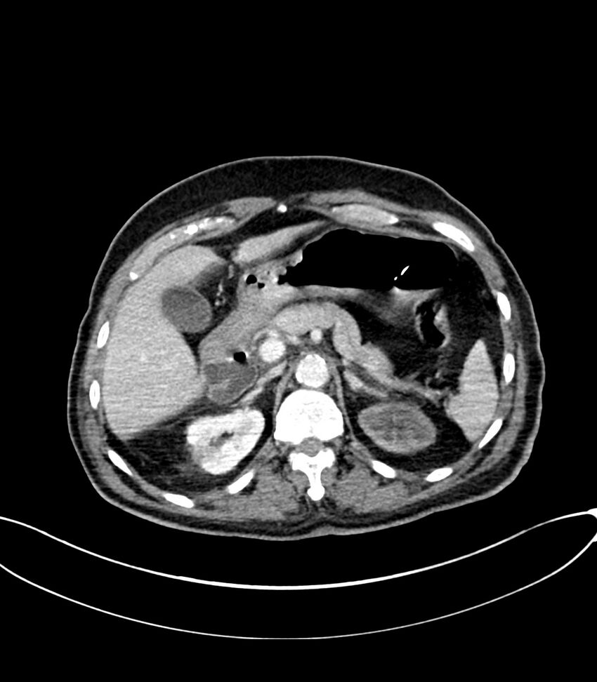 Acute arterial mesenteric ischemia (Radiopaedia 78238-90828 Axial C+ portal venous phase 42).jpg