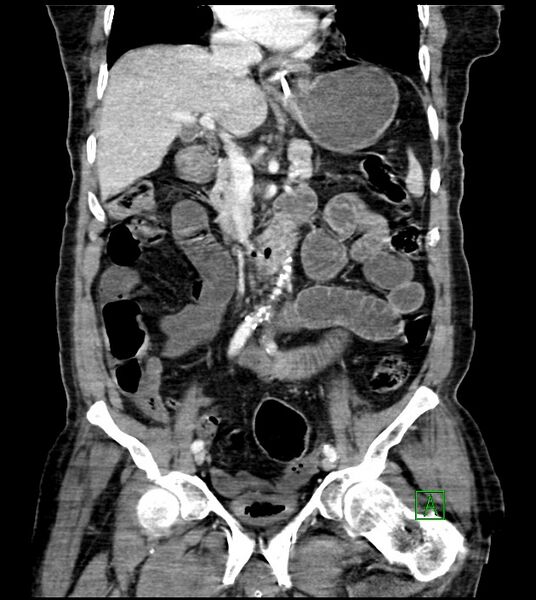 File:Acute arterial mesenteric ischemia (Radiopaedia 78238-90828 Coronal C+ portal venous phase 47).jpg