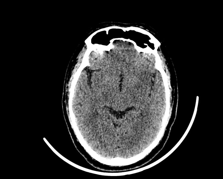 File:Acute cerebral infarct (Radiopaedia 35604-37123 Axial non-contrast 45).jpg