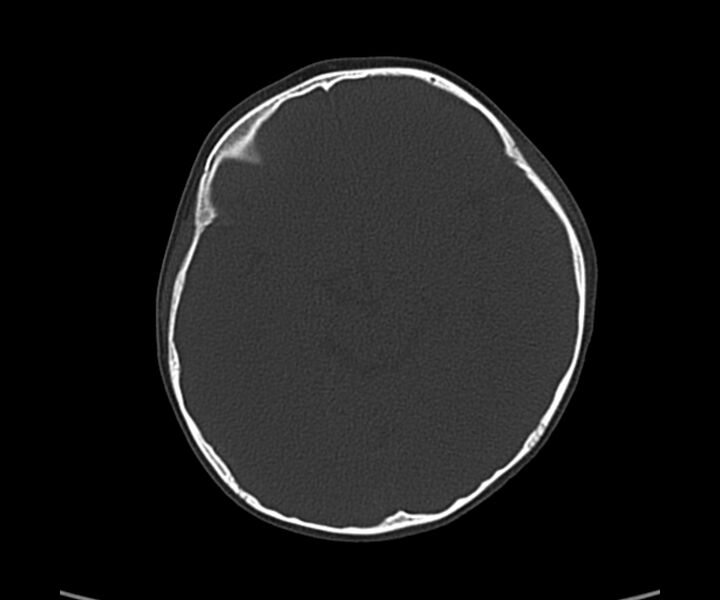 File:Acute hemorrhagic contusion (Radiopaedia 63660-72336 Axial bone window 29).jpg