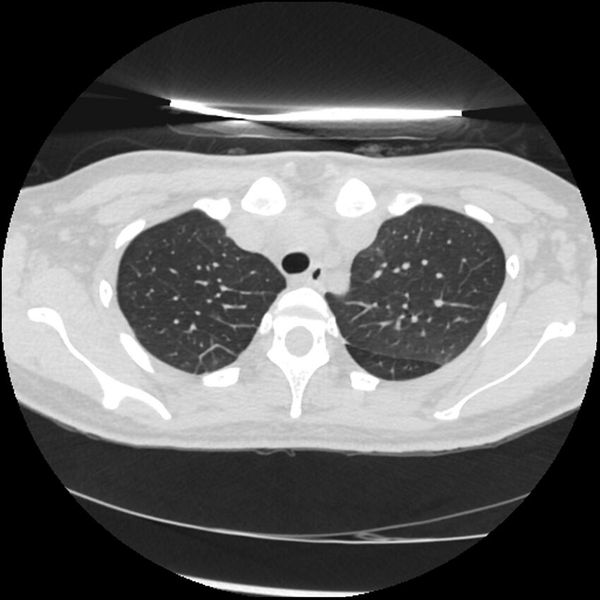 Acute lupus nephritis (Radiopaedia 45832-50107 Axial lung window 17).jpg