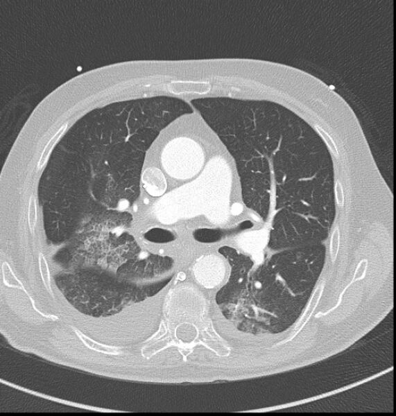 File:Acute myocardial infarction (Radiopaedia 23413-23481 lung window 20).jpg