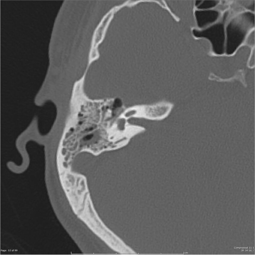 Acute otomastoiditis (Radiopaedia 28276-28512 Axial PTB bone window reformat 33).jpg
