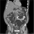 Acute pancreatitis (Radiopaedia 19135-19116 Coronal non-contrast 15).jpg