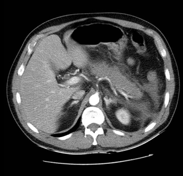 File:Acute pancreatitis - Balthazar E (Radiopaedia 23080-23110 Axial C+ arterial phase 19).jpg