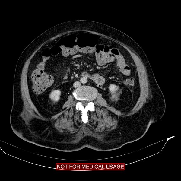 File:Acute pancreatitis with infected necrosis (Radiopaedia 26454-26585 Axial C+ delayed 21).jpg
