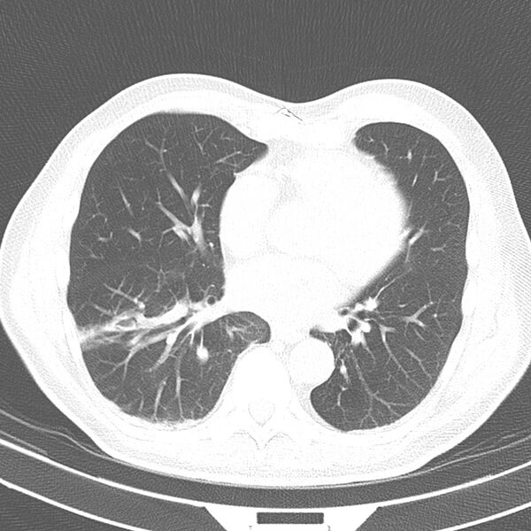 File:Acute pulmonary embolism (Radiopaedia 81677-95570 Axial lung window 28).jpg