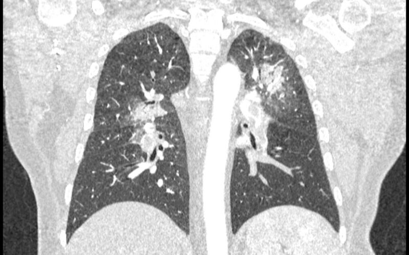 File:Acute pulmonary embolism with pulmonary infarcts (Radiopaedia 77688-89908 Coronal lung window 63).jpg