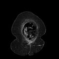 Acute pyelonephritis (Radiopaedia 25657-25837 Coronal renal parenchymal phase 13).jpg