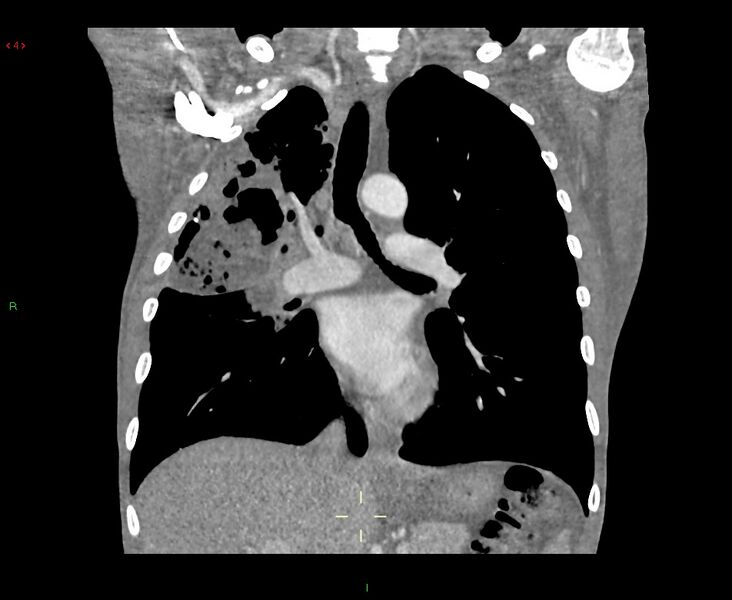 File:Acute right lung abscess (Radiopaedia 34806-36258 Coronal C+ arterial phase 29).jpg
